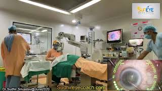 Unedited Unseen secret Moments in Operation Theatre during Cataract Surgery-DR SUDHIR SRIVASTAVA