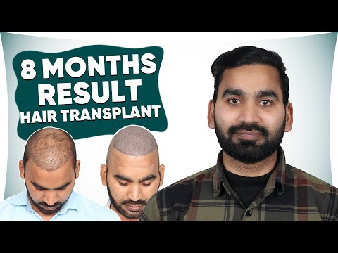 Hair Transplant in Trivandrum | 8 Months Result