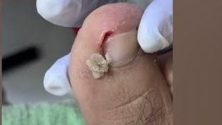 Ep_8919 Foot nails skin removal 👣 ชิ้นที่ร่วงออกไปคือเล็บไม่ใช่ตัวทำให้หนูเจ็บ 😅(clip from Thailand)