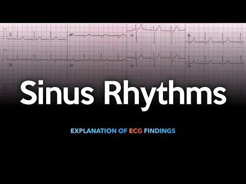 Sinus Rhythm ECG Explained