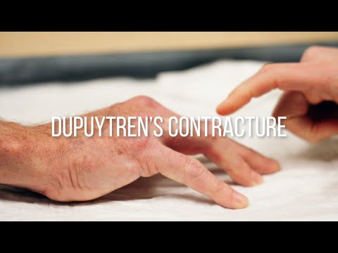 Dupuytren's Contracture Explained: Symptoms, Causes, and Treatments