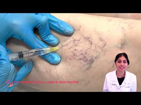 Sclerotherapy Varicose and Spider Vein Treatment | Dr. Shalini Gupta