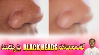 Magical Remedy to Remove Black Heads from Nose | Get Smooth Skin at Home | Dr.Manthena
