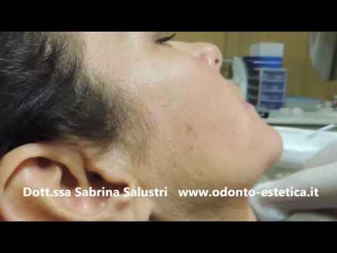 Decolorazione di pelle di faccia e mani Dove cancella posti di pigmentary in Almaty
