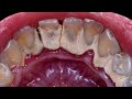 21 yo. Female's Teeth | Tartar Removal | Scaling | Dentist | Dokter Gigi Tri Putra