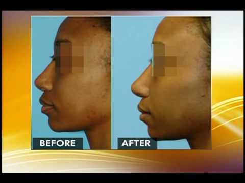 Revision Rhinoplasty by Washingtonian Rhinoplasty Specialist Surgeon Dr. Naderi