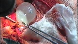 Brain echinococcus surgeries of doctor Mamikon Yeghunyan