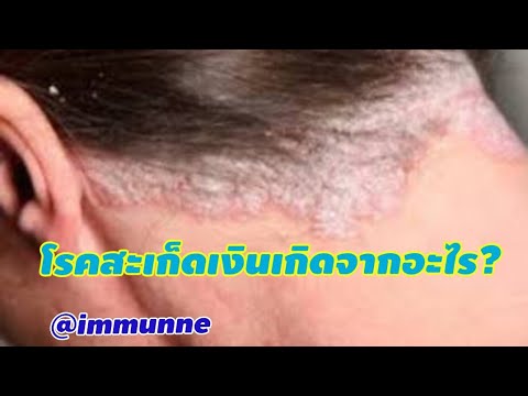 การรักษาของกระเทียม neurodermatitis หาครีมกลาก