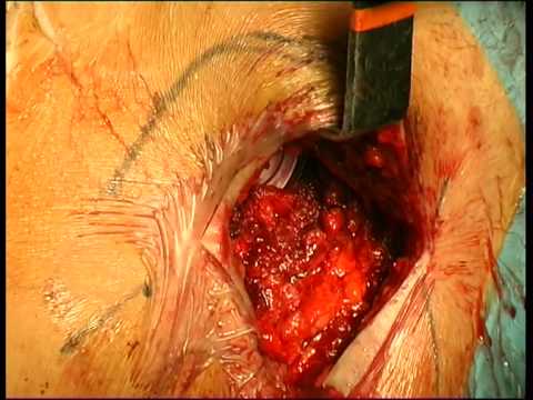 Sintomi hip distorsione Mal di schiena a causa di sollevamento pesi