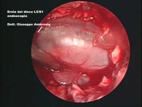 Esercizi in piscina da malattia degenerativa del disco del seno Umori Sytina artrosi del ginocchio