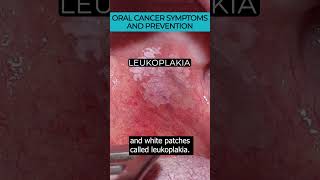 Download lagu Recognizing early signs and preventing oral cancer 🎗️🚭 mp3