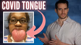 The Mystery of COVID TONGUE Explained