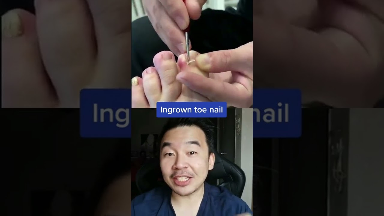 Ingrown Toe Nail #shorts