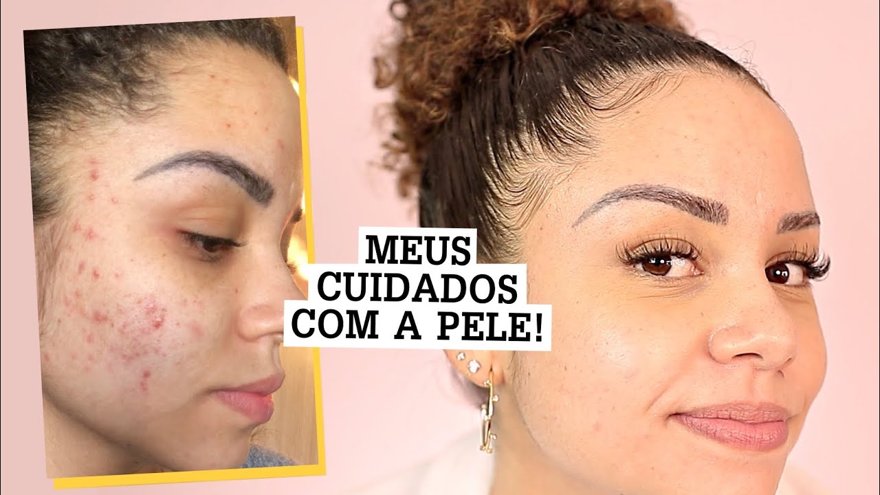 COMO CUIDEI DAS MINHAS ESPINHAS?