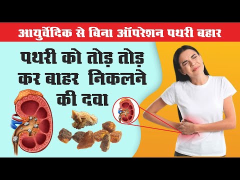 किडनी स्टोन के लक्षण और बचाव | Kidney Stone Early Symptoms And Prevention | 📞 9411632933