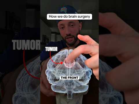 This is how we remove a brain tumor. 🧠 #neurosurgeon #neurosurgery #medical #doctor #surgery