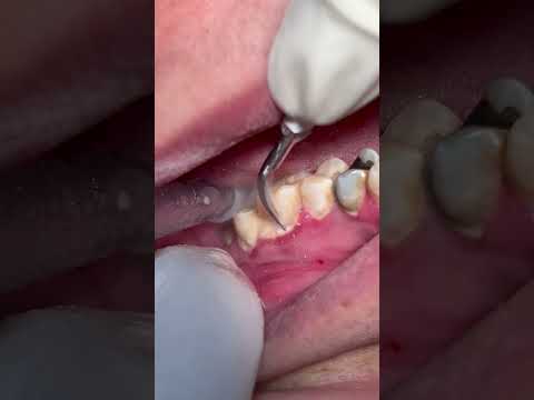 Scaling teeth from tartar and calculus #dental #satisfying