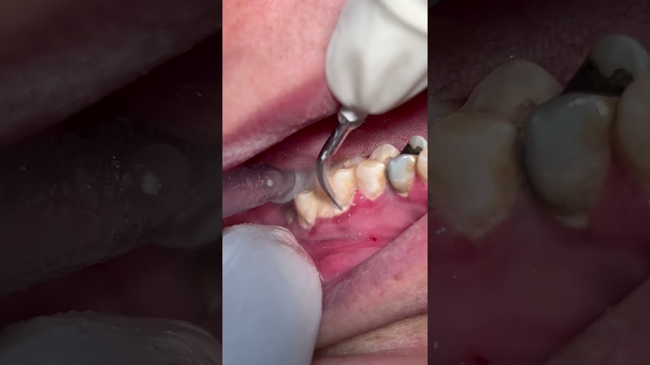 Scaling teeth from tartar and calculus #dental #satisfying