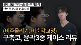 (비주올리기, 비순각교정) 구축코, 윤곽3종 케이스 리뷰 [늑떼선생김현주의 수술사례 및 케이스리뷰]