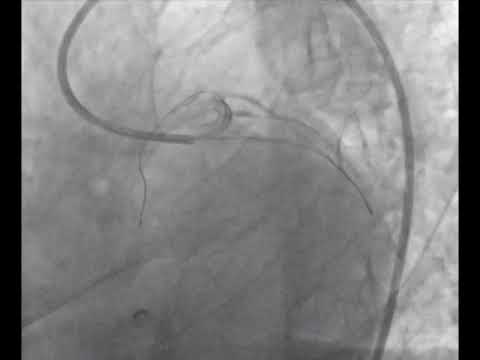 Video 16.4 LMC-LAD-CXA TAP tekniği