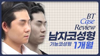 남자코성형 기능코성형 1개월차 케이스리뷰 ㅣ비티성형외과