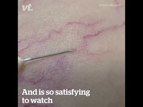 แผลเล็ก ๆ บนหน้าอก ครีมยกเต้านม