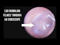 Ear Rumbling Filmed With An Endoscope (Tensor Tympani Muscle)