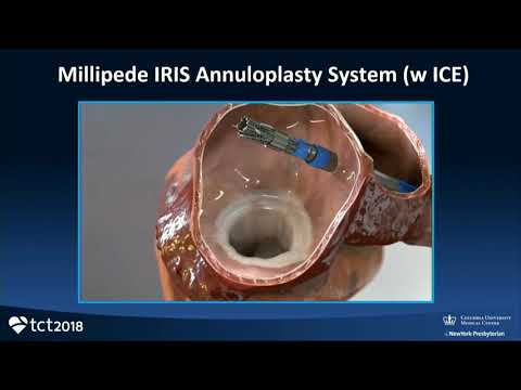 CVI 2019_Thursday 7/18_ Breaking Boundaries with Mitral Valve Therapy_Martin Leon, MD