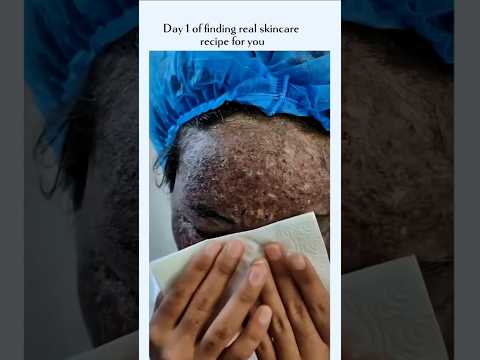 Phenol Peel Skin Healing Journey Before and After #Short #skinconfidence #transformationstory