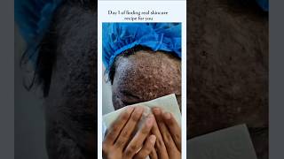 Phenol Peel Skin Healing Journey Before and After #Short #skinconfidence #transformationstory