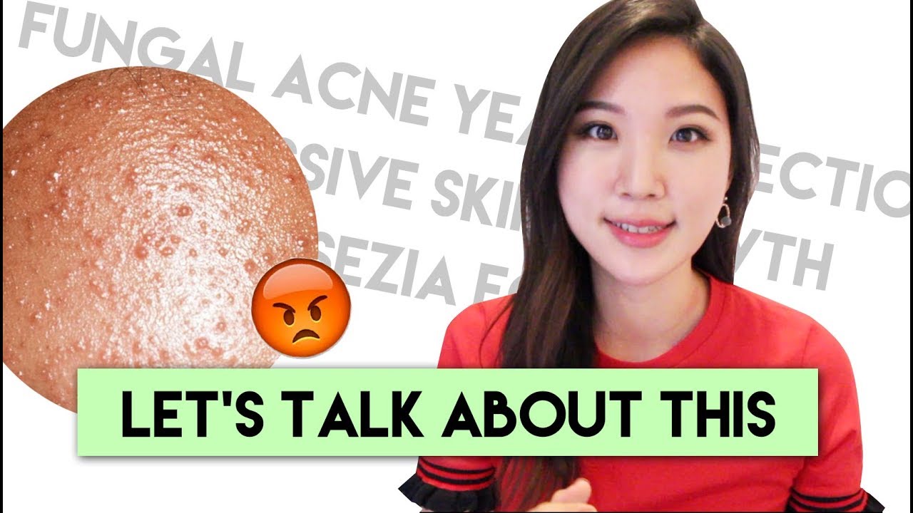 How To Treat Fungal Acne : Tiny Little Bumps on the Forehead