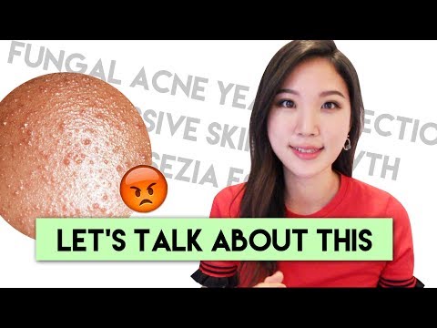 How To Treat Fungal Acne : Tiny Little Bumps on the Forehead Video