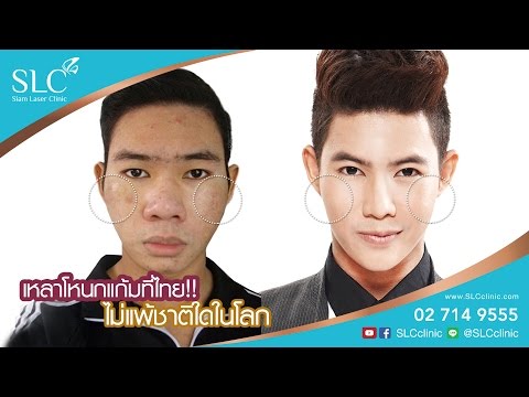 เหลาโหนกแก้มที่ไทย ไม่แพ้ชาติใดในโลก ลดโหนกแก้มที่ SLC