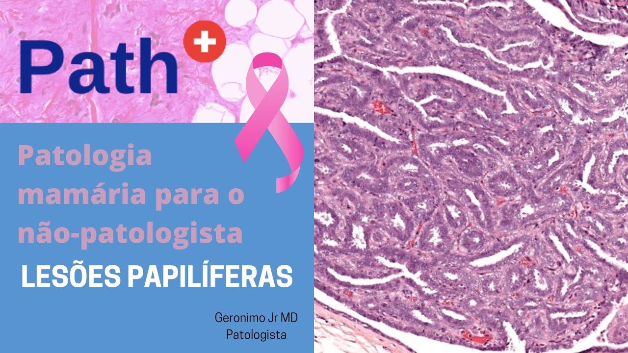 Lesões Papilíferas - Patologia mamária para o não-patologista.