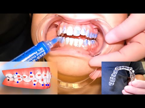 Invisalign Braces Fitting Appointment - Step by Step Breakdown! McKinney Orthodontist