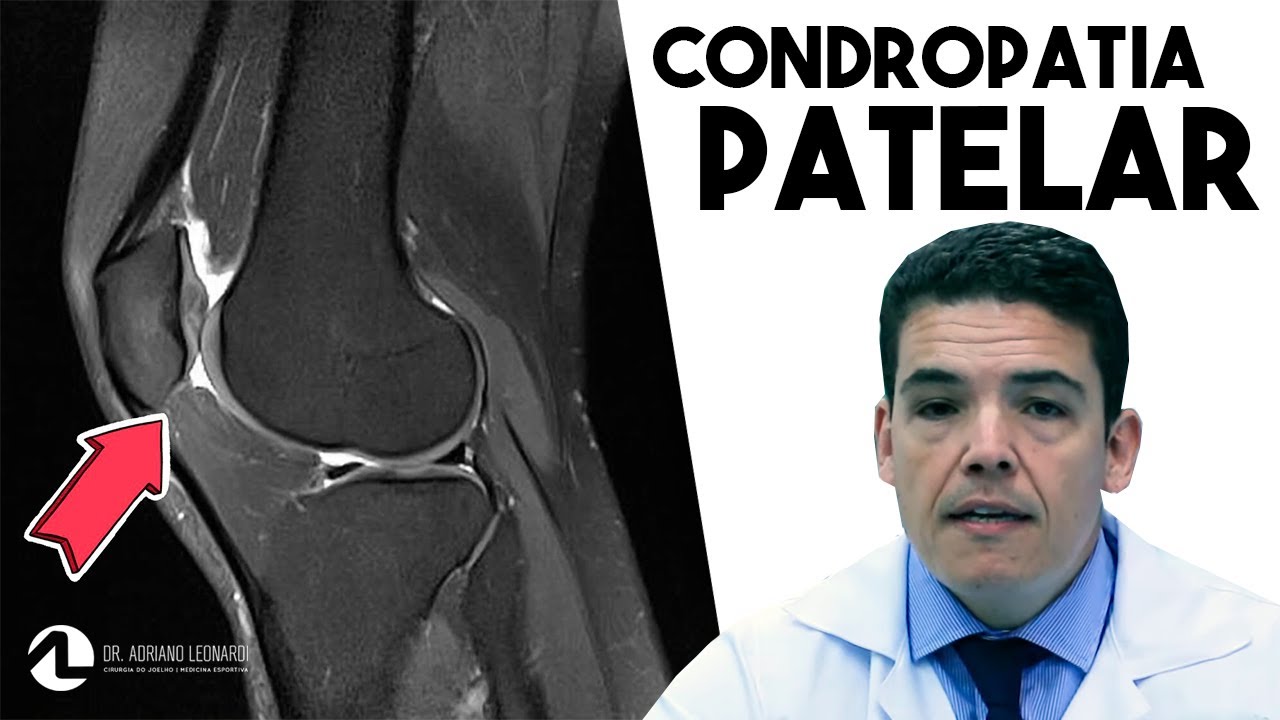 CONDROPATIA PATELAR: O que é, sintomas e como tratar