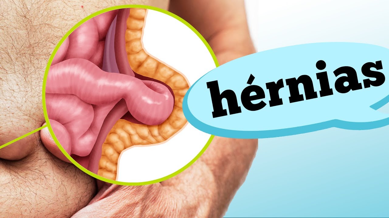 TIPOS DE HÉRNIA: O QUE É E COMO RECONHECER