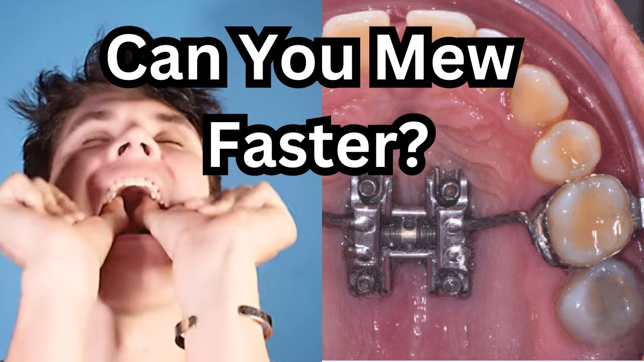 Yes. Thumb Pulling: Full Guide on Mewing Faster (w/ sauce at the end)
