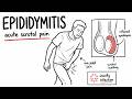 Epididymitis Explained | Causes, Symptoms, Diagnosis and Treatment