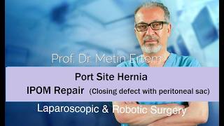Miniaturka - Port Site Hernia. IPOM Repair. Closing the defect with sac. Metin Ertem MD.FACS