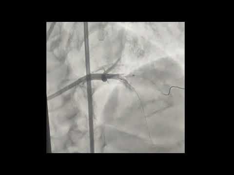 Modified Mini Crush Bifurcation Stenting