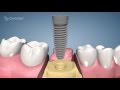 Dental Implant Procedure - One Stage