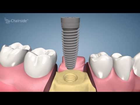 Dental Implant Procedure - One Stage Video