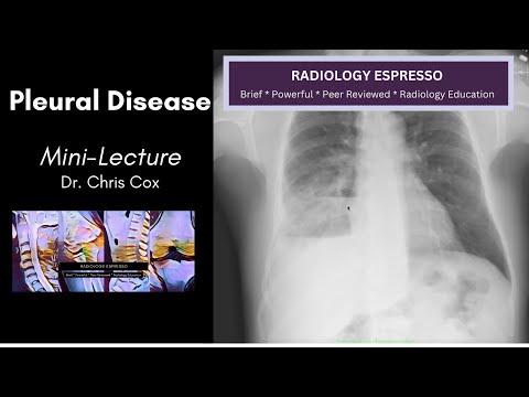 BASICS OF PLEURAL DISEASE: Mini-lecture, Dr. Chris Cox