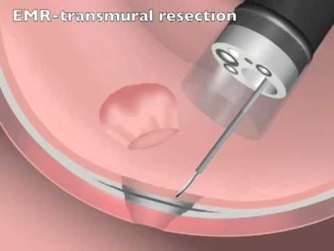 Resección Mucosa Endoscópica (RME)