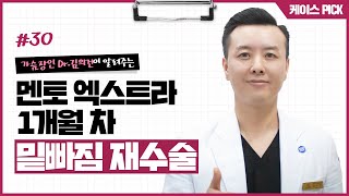 수술 4년 후 밑빠짐, 재수술 후 모양의 변화는? 멘토 엑스트라 재수술 1개월차!
