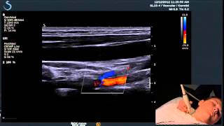 Hot Tips - Finding the Vertebral Artery with Ultrasound
