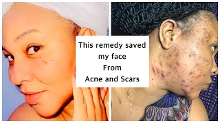 THIS NATURAL REMEDY SAVED MY FACE FROM (ACNE AND PIMPLES): clears (dark spots ) | amazing solution.