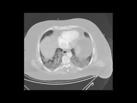 COVID 19 Pneumonie CT-Thorax