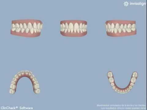 Caso de estudio: Paciente de Invisalign
